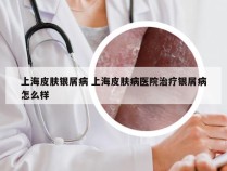 上海皮肤银屑病 上海皮肤病医院治疗银屑病怎么样