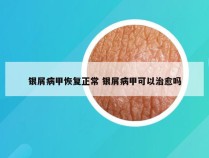 银屑病甲恢复正常 银屑病甲可以治愈吗