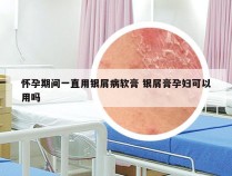 怀孕期间一直用银屑病软膏 银屑膏孕妇可以用吗