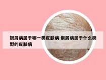 银屑病属于哪一类皮肤病 银屑病属于什么类型的皮肤病