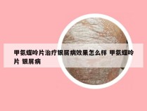 甲氨蝶呤片治疗银屑病效果怎么样 甲氨蝶呤片 银屑病