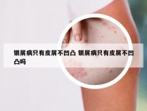 银屑病只有皮屑不凹凸 银屑病只有皮屑不凹凸吗