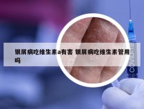 银屑病吃维生素a有害 银屑病吃维生素管用吗
