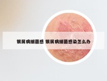 银屑病细菌感 银屑病细菌感染怎么办