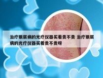 治疗银屑病的光疗仪器买着贵不贵 治疗银屑病的光疗仪器买着贵不贵呀