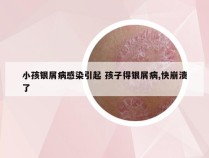 小孩银屑病感染引起 孩子得银屑病,快崩溃了