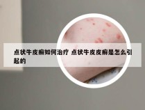 点状牛皮癣如何治疗 点状牛皮皮癣是怎么引起的