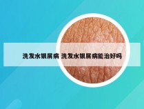 洗发水银屑病 洗发水银屑病能治好吗