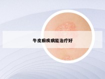 牛皮癣疾病能治疗好