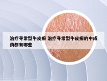 治疗寻常型牛皮癣 治疗寻常型牛皮癣的中成药都有哪些