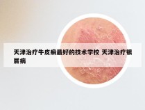 天津治疗牛皮癣最好的技术学校 天津治疗银屑病