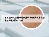 银屑病一定会越来越严重吗 银屑病一定会越来越严重吗怎么治疗