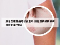 脓包型银屑病可以自愈吗 脓包型的银屑病有治愈的案例吗?