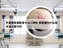 不是银屑病能用卡泊三醇吗 银屑病为什么涂卡泊三醇不好