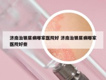 济南治银屑病哪家医院好 济南治银屑病哪家医院好些