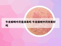 牛皮癣喝中药是清毒吗 牛皮癣喝中药效果好吗