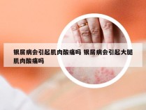 银屑病会引起肌肉酸痛吗 银屑病会引起大腿肌肉酸痛吗