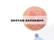 吉林市牛皮癣 吉林市皮肤病诊所
