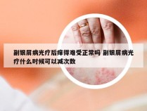 副银屑病光疗后痒得难受正常吗 副银屑病光疗什么时候可以减次数