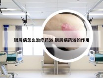 银屑病怎么治疗药浴 银屑病药浴的作用