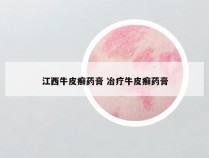 江西牛皮癣药膏 冶疗牛皮癣药膏