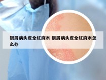 银屑病头皮全红麻木 银屑病头皮全红麻木怎么办