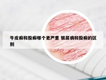 牛皮癣和股癣哪个更严重 银屑病和股癣的区别