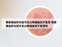 银屑病治好以后不忌口喝酒抽完不复发 银屑病治好以后不忌口喝酒抽完不复发吗