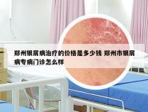 郑州银屑病治疗的价格是多少钱 郑州市银屑病专病门诊怎么样