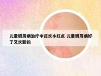 儿童银屑病治疗中还长小红点 儿童银屑病好了又长新的