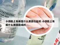 小孩脸上有癣是什么原因引起的 小孩脸上有癣什么原因造成的