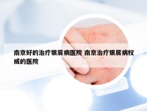 南京好的治疗银屑病医院 南京治疗银屑病权威的医院