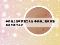 牛皮癣上面有脓泡怎么办 牛皮癣上面有脓泡怎么办用什么药