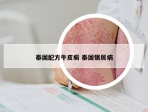泰国配方牛皮癣 泰国银屑病