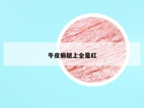 牛皮癣腿上全是红