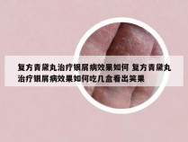 复方青黛丸治疗银屑病效果如何 复方青黛丸治疗银屑病效果如何吃几盒看出笑果