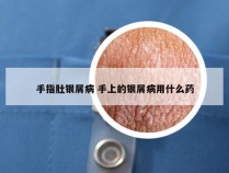手指肚银屑病 手上的银屑病用什么药