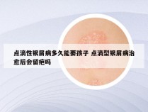 点滴性银屑病多久能要孩子 点滴型银屑病治愈后会留疤吗