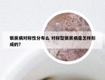 银屑病对称性分布么 对称型银屑病是怎样形成的?