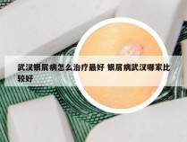 武汉银屑病怎么治疗最好 银屑病武汉哪家比较好
