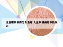 儿童银屑病要怎么治疗 儿童银屑病能不能根治