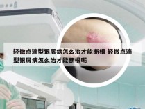 轻微点滴型银屑病怎么治才能断根 轻微点滴型银屑病怎么治才能断根呢