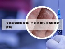 大腿内侧银屑病用什么药膏 在大腿内侧的银屑病