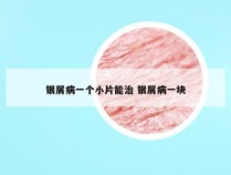 银屑病一个小片能治 银屑病一块