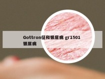 Gottron征和银屑病 gr1501 银屑病