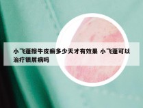 小飞蓬擦牛皮癣多少天才有效果 小飞蓬可以治疗银屑病吗