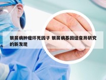 银屑病肿瘤坏死因子 银屑病基因组变异研究的新发现