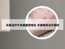 长春治疗牛皮癣医院排名 长春哪家治牛癣好