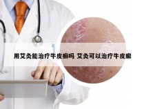 用艾灸能治疗牛皮癣吗 艾灸可以治疗牛皮廨