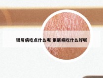 银屑病吃点什么呢 银屑病吃什么好呢